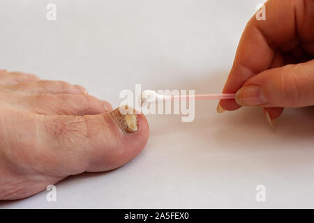 La femmina si applica a mano un bastoncino di cotone crema al toenail colpite dal fungo. Fungo sull'alluce. Copia dello spazio. Foto Stock