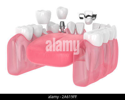 3D render della ganascia con impianti dentali e ponti su sfondo bianco Foto Stock