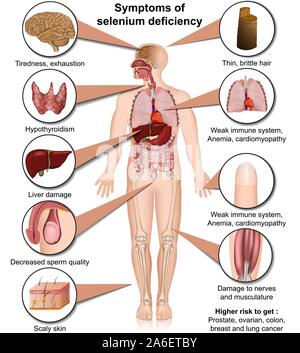 Una carenza di selenio medical illustrazione vettoriale isolati su sfondo bianco Una infografica Illustrazione Vettoriale