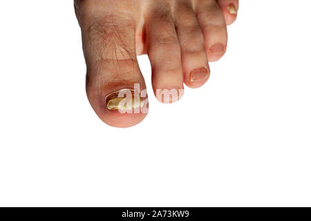 Il fungo della toenails. Toenail piastra è influenzata da fungo. Le piastre delle unghie delle dita dei piedi sono sfigurato. Isolato. Foto Stock