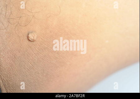 Massa peduncolato pelle tag o acrochondon o soft fibroma. Papilloma bump sul corpo maschio macro shot sulla coscia Foto Stock