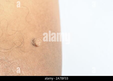 Massa peduncolato pelle tag o acrochondon o soft fibroma. Papilloma bump sul corpo maschio macro shot sulla coscia Foto Stock