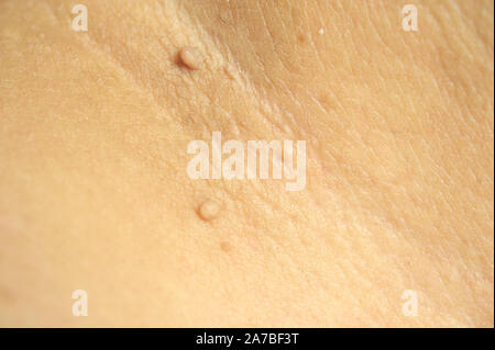 Massa peduncolato pelle tag o acrochondon o soft fibroma. Papilloma bump sul corpo maschio macro shot sulla coscia Foto Stock