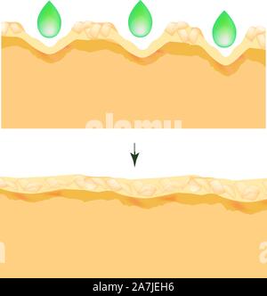 Pori allargata. La struttura della pelle. Rughe, acne cicatrice. Pulizia e restringendo i pori. Infographics. Illustrazione Vettoriale sulla isolato Illustrazione Vettoriale