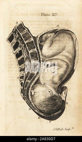 Vista laterale della testa di feto sprofondate nel bacino durante il lavoro avanzate. Incisione su rame di Andrew Bell dopo una illustrazione di Jan van Rymsdyk da William Smellie una serie di tavole anatomiche, Charles Elliot, Edimburgo, 1780. Foto Stock