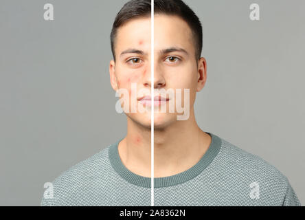 Giovane uomo con e senza il problema di acne su sfondo grigio Foto Stock