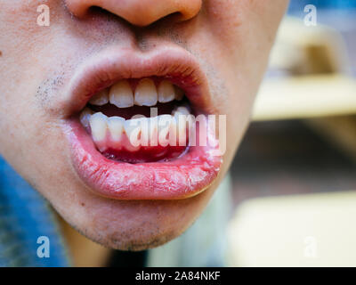 A bocca asciutta e cattivo denti di un uomo su una fredda giornata close up Foto Stock