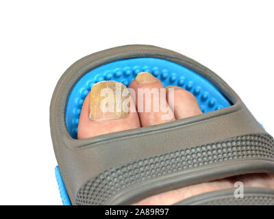 Toenail fungo, onicomicosi, dita del piede e il piede in flip-flop Foto Stock