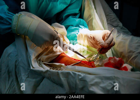 Operazione di trattamento chirurgico sulla gamba utilizzando diversi strumenti chirurgici durante il funzionamento la camera in ospedale. Foto Stock