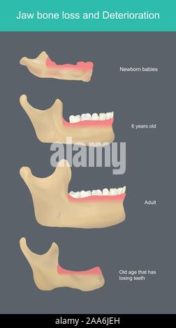 Ganascia perdita ossea e il deterioramento. Quando si nasce, il corpo ha bisogno di calcio per costruire le ossa e denti. Quando la vecchiaia, il corpo ha bisogno di calcio utilizzati per la riparazione di più Illustrazione Vettoriale