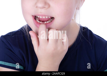 Denti del bambino con riempimenti. Piccola Ragazza tira fuori un dente di latte su uno sfondo bianco. Foto Stock