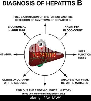 La diagnosi di infezione da epatite B. Giornata Mondiale Epatite. Infographics. Illustrazione Vettoriale su sfondo isolato. Illustrazione Vettoriale