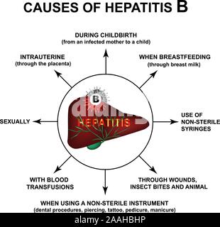 Cause di epatite B. Giornata Mondiale Epatite. Infographics. Illustrazione Vettoriale su sfondo isolato. Illustrazione Vettoriale