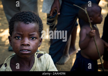 Un bambino del Malawi guarda fotocamera (bambino con kwashiokor in background) Foto Stock