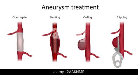 Trattamento di aneurisma, illustrazione. Confronto di clipping, chirurgia aperta la riparazione, stenting e bobinatura. Foto Stock