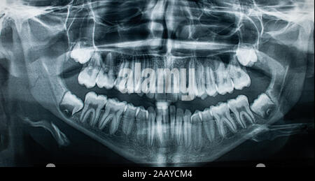 X-ray ganascia vista anteriore ,concetto medico , health care, Foto Stock