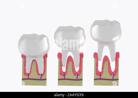Estrazione molare. La perdita dei denti struttura anatomica. 3d Illustrazione medica. Foto Stock