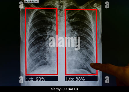 Medico mano punta il dito contro il paziente del polmone di flim x-ray. è stata diagnosticata la tubercolosi, a comunicare i risultati della diagnosi per i pazienti Foto Stock