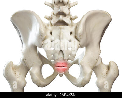 3D Rendering accurato dal punto di vista medico illustrazione di un coccyx rotto Foto Stock