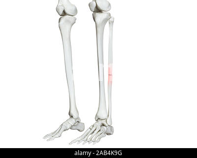 3D Rendering accurato dal punto di vista medico illustrazione di una fibula rotto Foto Stock