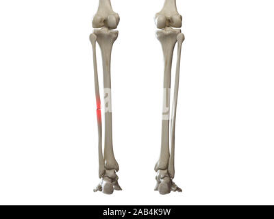 3D Rendering accurato dal punto di vista medico illustrazione di una fibula rotto Foto Stock