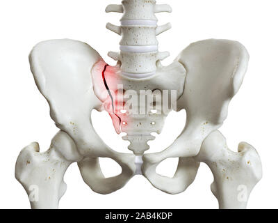 3D Rendering accurato dal punto di vista medico illustrazione di un sacrum rotto Foto Stock