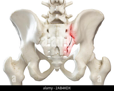 3D Rendering accurato dal punto di vista medico illustrazione di un sacrum rotto Foto Stock