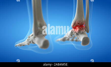 3D Rendering accurato dal punto di vista medico illustrazione di un artritico articolazione della caviglia Foto Stock