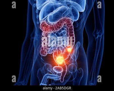 3D Rendering accurato dal punto di vista medico illustrazione di cancro al colon Foto Stock