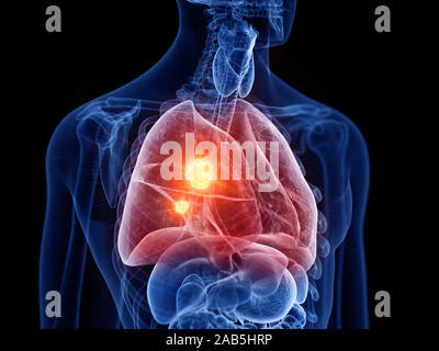 3D Rendering accurato dal punto di vista medico illustrazione del cancro ai polmoni Foto Stock