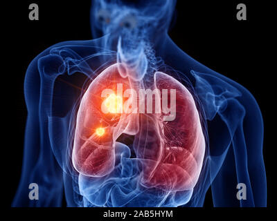 3D Rendering accurato dal punto di vista medico illustrazione del cancro ai polmoni Foto Stock