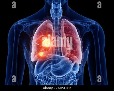 3D Rendering accurato dal punto di vista medico illustrazione del cancro ai polmoni Foto Stock