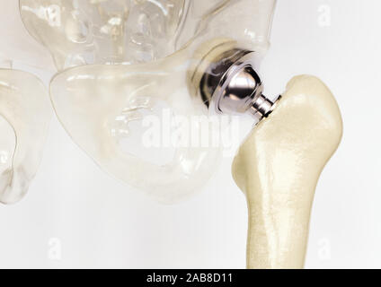 Articolazione artificiale dell'anca dopo grave osteoartrite - 3D Rendering Foto Stock