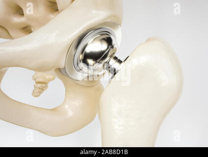 Articolazione artificiale dell'anca dopo del collo del femore frattura - 3D Rendering Foto Stock