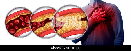 Attacco di cuore malattia dolore come una anatomia medica nozione di malattia con una persona che soffre di una malattia cardiaca come un doloroso evento coronarico dovuta. Foto Stock