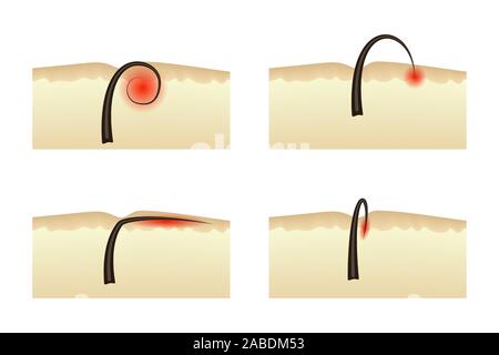 Il fenomeno dei peli incarniti dopo la depilazione. Illustrazione Vettoriale. Infiammazione della pelle dermatologia. Illustrazione Vettoriale