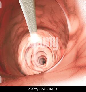 Vista interna delle pareti intestinali. La colonscopia è l'esame endoscopico dell'intestino crasso e la parte distale di piccolo intestino Foto Stock