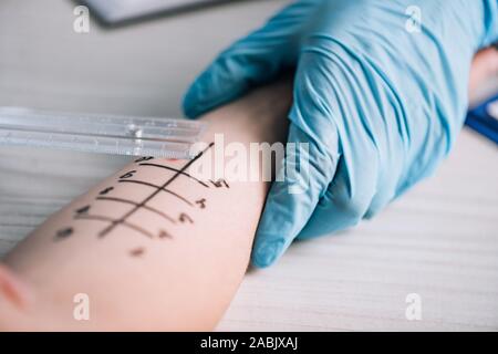 Vista ritagliata di dottore in guanti in lattice facendo prova di allergia alla donna in clinica Foto Stock