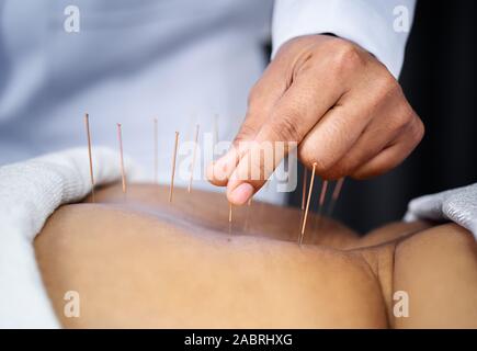 Close-up di senior indietro femmina con aghi di acciaio durante la procedura della terapia di agopuntura Foto Stock