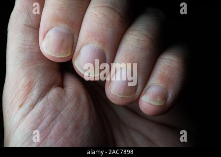 La psoriasi è una malattia autoimmune che colpisce il chiodo e la pelle. close up della psoriasi chiodo su sfondo scuro. Foto Stock