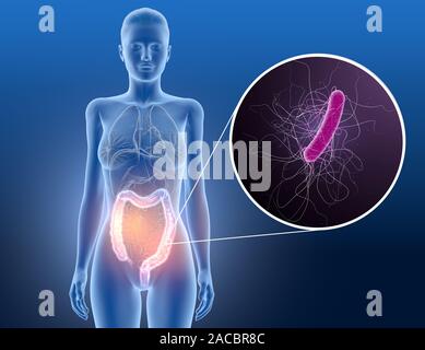 3D illustrazione che mostra la colite, Clostridium difficile batteri nell'intestino crasso Foto Stock