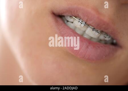 Sistema brasket in bocca sorridente, close-up labbra