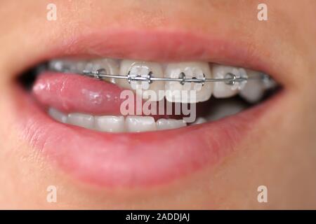 Sistema brasket in bocca sorridente, close-up labbra