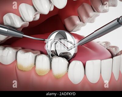 3D illustrazione che mostra gli strumenti del dentista e la placca dentale del modello. 3D'illustrazione. Foto Stock