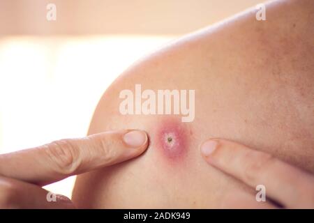 Donna cerca di schiacciare bollire sulla sua spalla. La gente, la medicina e la cura della pelle concept Foto Stock