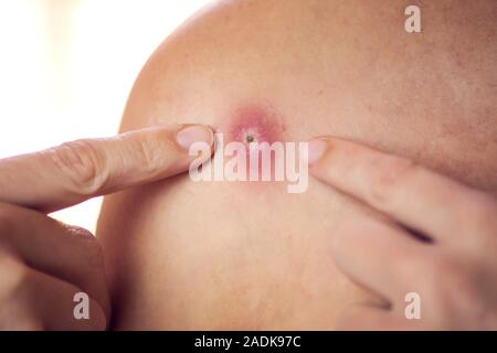 Donna cerca di schiacciare bollire sulla sua spalla. La gente, la medicina e la cura della pelle concept Foto Stock