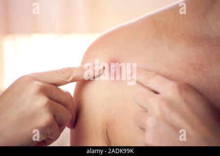 Donna cerca di schiacciare bollire sulla sua spalla. La gente, la medicina e la cura della pelle concept Foto Stock