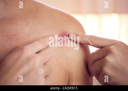 Donna cerca di schiacciare bollire sulla sua spalla. La gente, la medicina e la cura della pelle concept Foto Stock