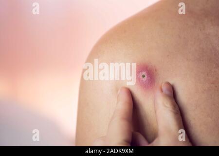 Donna cerca di schiacciare bollire sulla sua spalla. La gente, la medicina e la cura della pelle concept Foto Stock