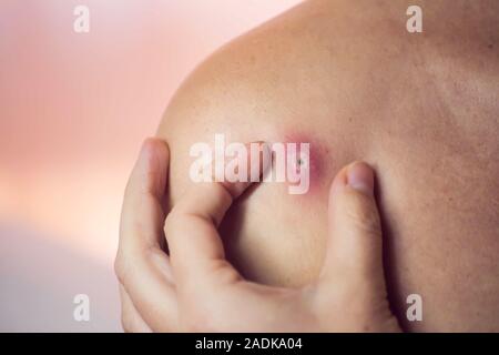 Donna cerca di schiacciare bollire sulla sua spalla. La gente, la medicina e la cura della pelle concept Foto Stock